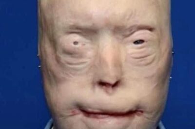 Patrick Hardison received a new face after third-degree burns, this is him today (NG)